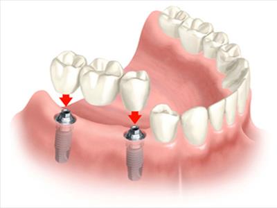 implantologia dentale